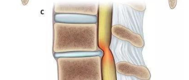 医生说的“腰椎管狭窄症”,到底是个什么东西?